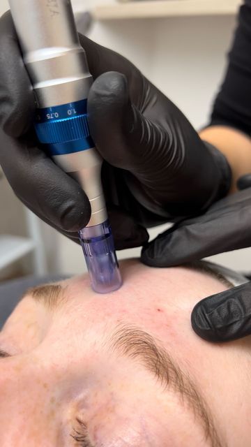 Microneedling with vitamins